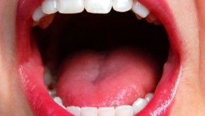 dry-mouth-remedy